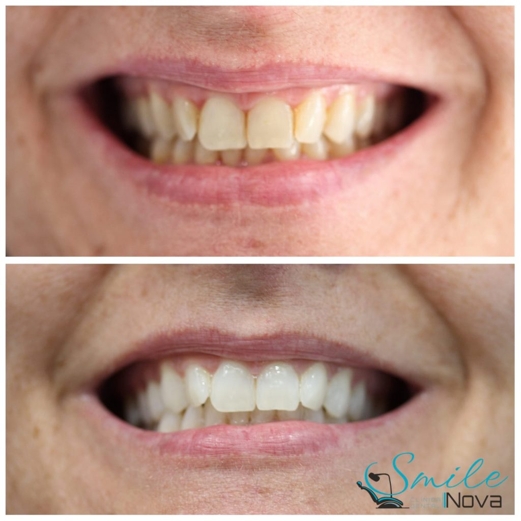 Blanqueamiento dental por fotoactivación: ¿qué es y cómo funciona?