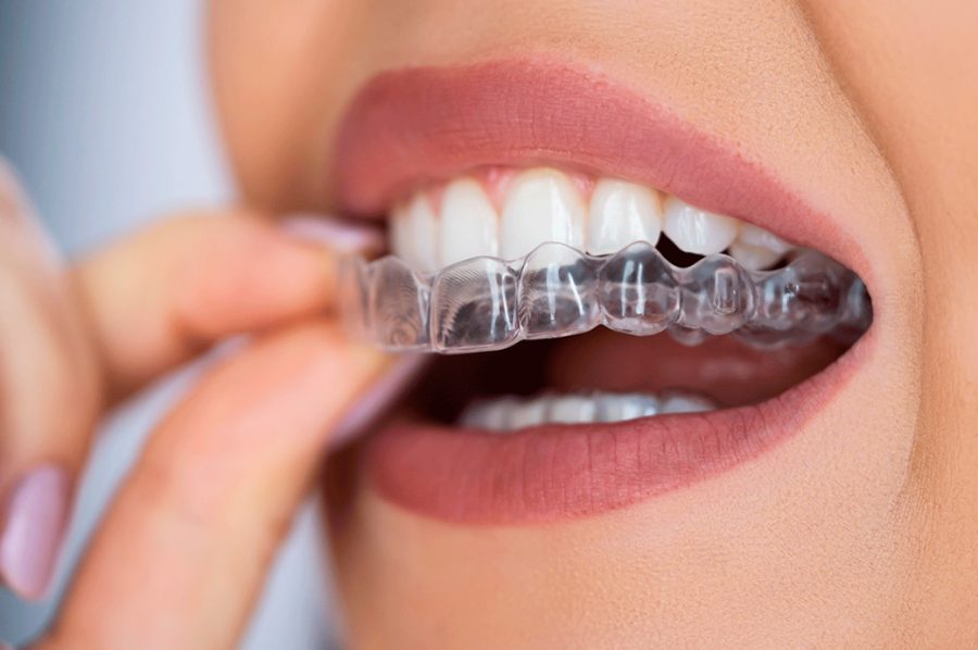 ¿Cómo se mueven los dientes con ortodoncia invisible?