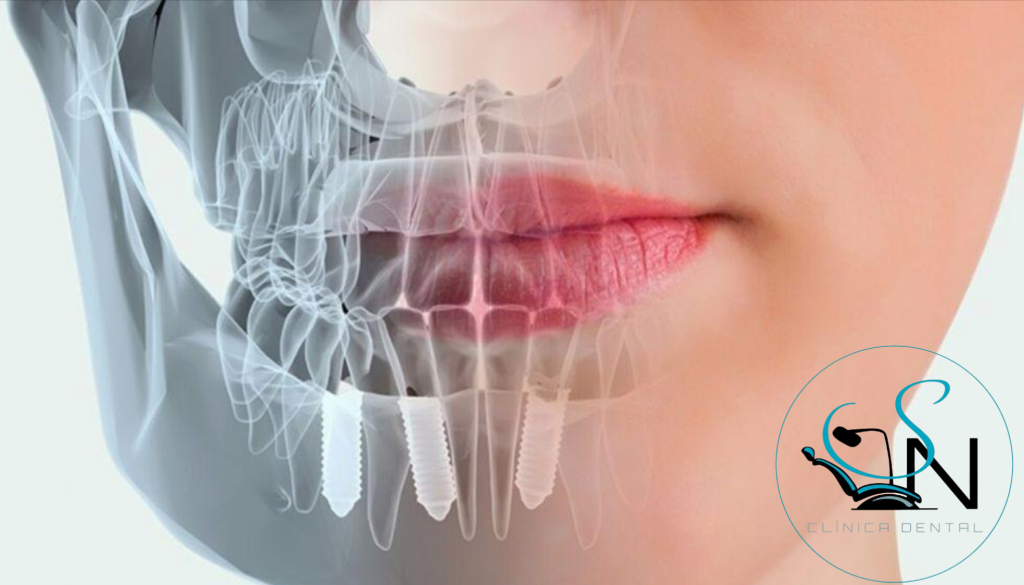  ¿Qué es la cirugía guiada en implantes dentales y por qué cada vez más personas la eligen?