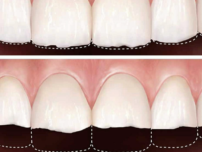 persona observando desgaste dental en dientes delanteros