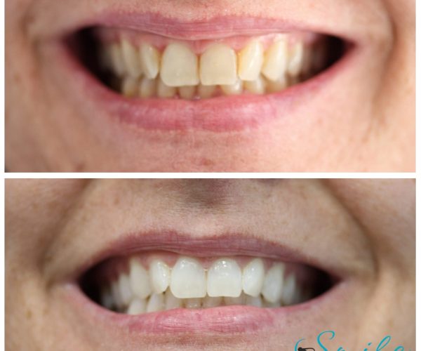 Blanqueamiento dental smilenova