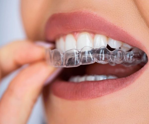 ortodoncia-invisalign